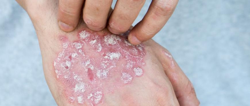 main of Psoriasis Treatment Options
