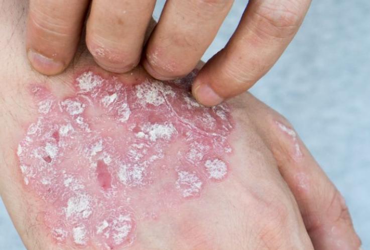 s-thumbnail of Psoriasis Treatment Options